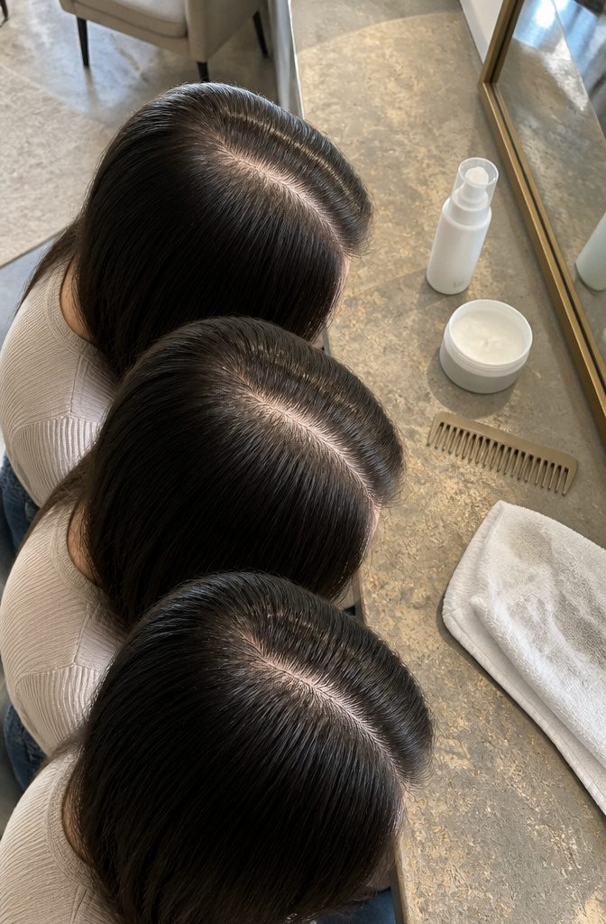 Hair samples showing thin normal and thick density levels